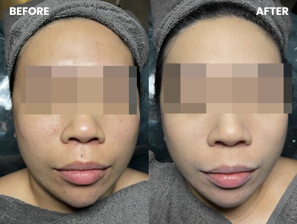 Korean no1 - BB Glow Facial Treatment 6 case Aaa