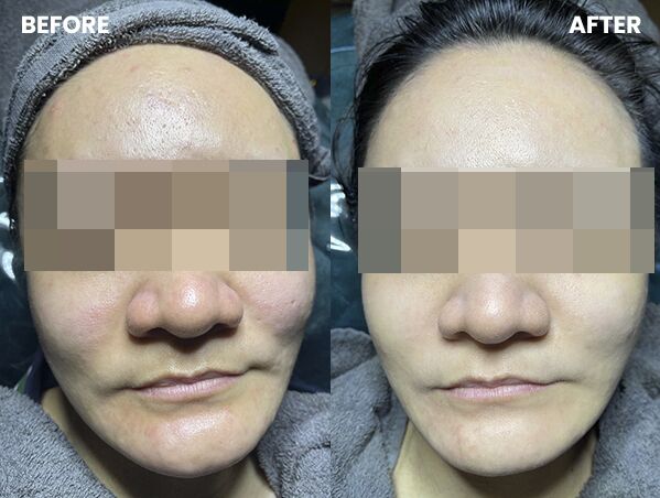Korean no1 - BB Glow Facial Treatment 7 case Bbb