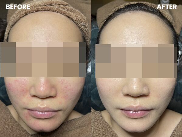 Korean no1 - BB Glow Facial Treatment 5 case Ccc