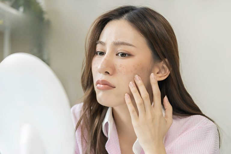 Sine Beauty 20 Individual practicing stress management techniques for combating stress-induced acne